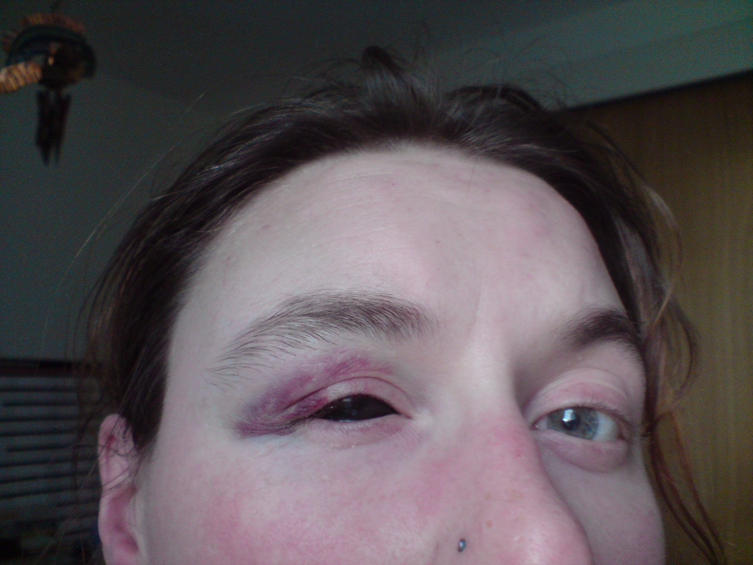 Um. Yeah. Black eye and a black eye. I landed on my forehead, about 2 inches above the end of the eyebrow. You can just see the small cut.